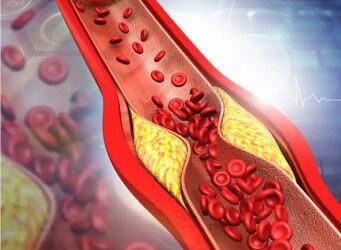 National Vascular Associates – Mountain Spring Vascular